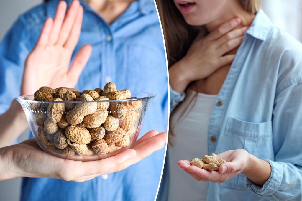 Two men in the UK curated by the deadly allergy of peanuts thanks to the new study
